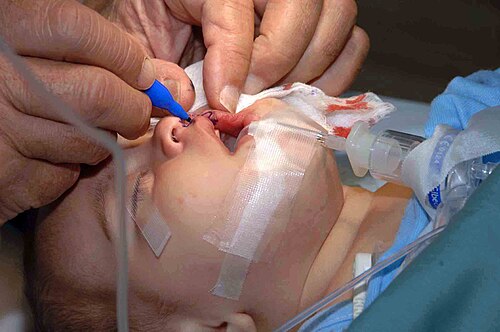 Reconstructive surgery